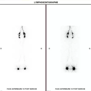 lymphoscintigraphie.jpg
