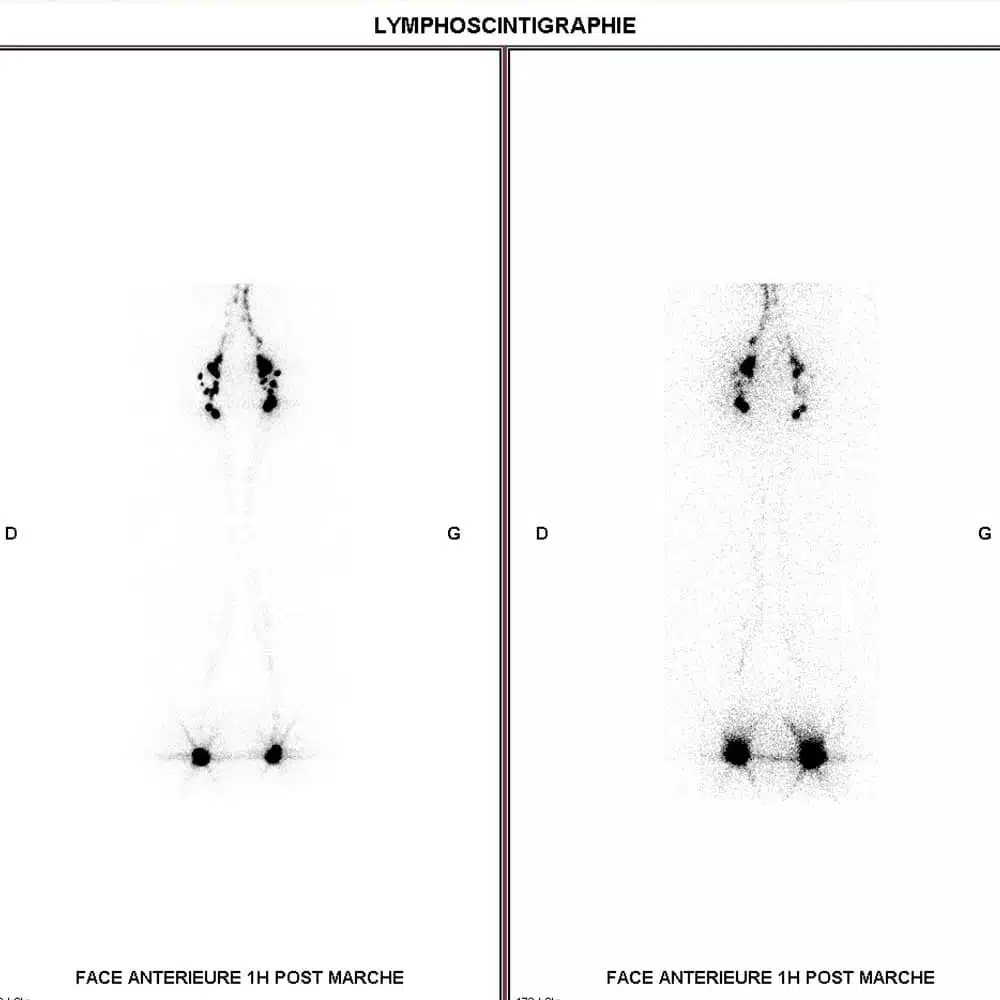 lymphoscintigraphie.jpg