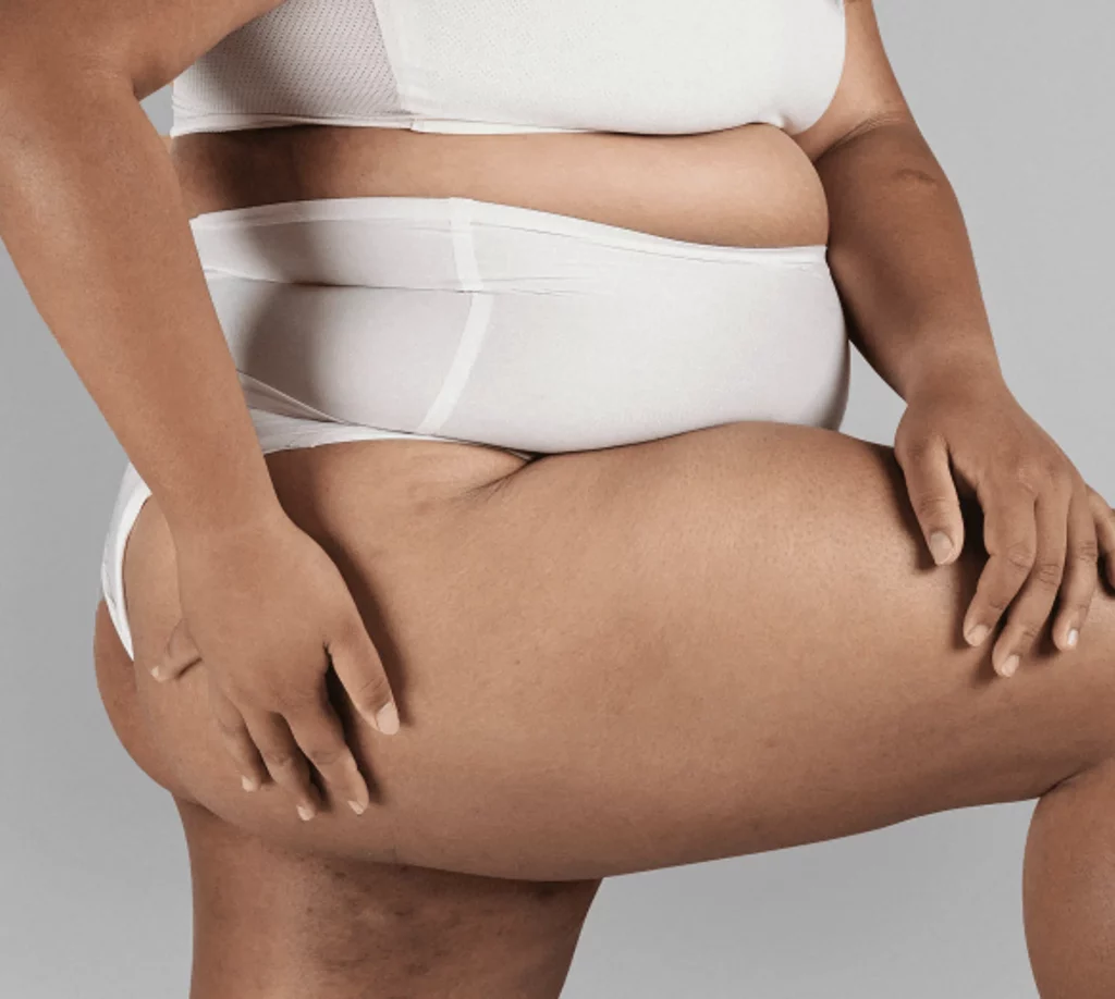 detecter image dr nicolas zwillinger clinique lipoedeme2.png