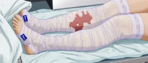 Comment bien gérer les écoulements après l’opération ?