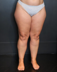 lipœdème avant 1 chri