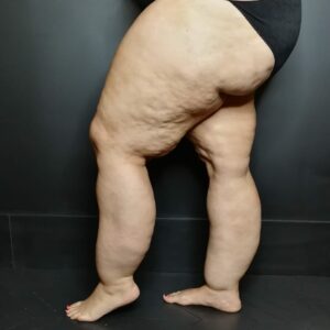 lipœdème cas n°4 b