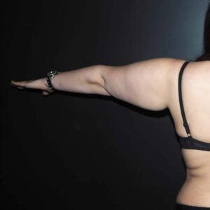 lipœdème Bras avant op