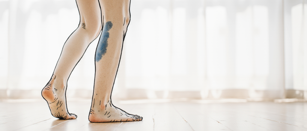 Comment lutter contre la fragilité vasculaire ? fragilité vasculaire