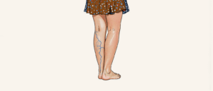 phlébite Lipœdème